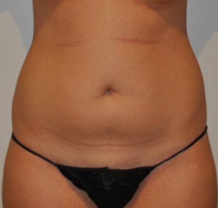 Before Image: Standard Liposuction - front