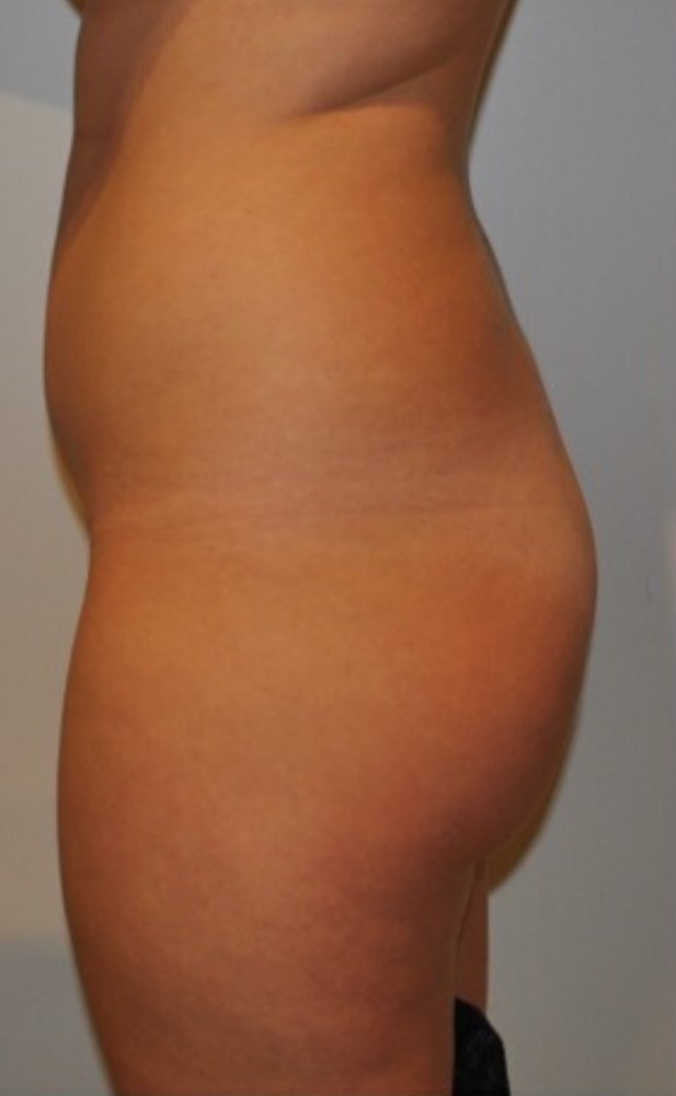 Before Image: Standard Liposuction - left-side