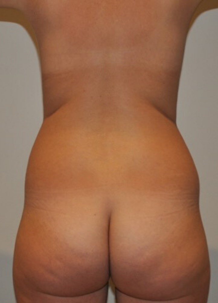 Before Image: Standard Liposuction - back