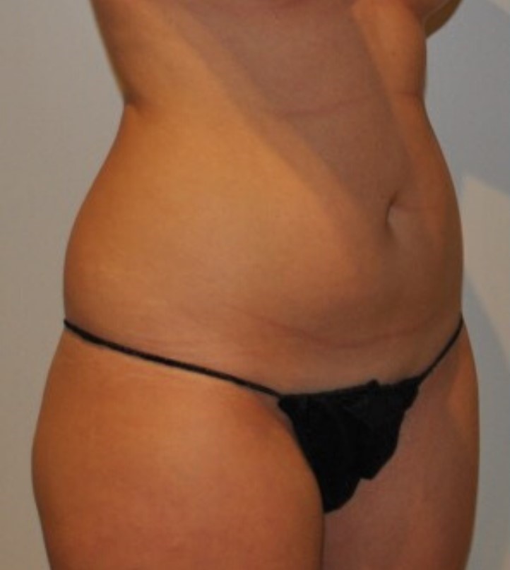 Before Image: Standard Liposuction - right-front-oblique