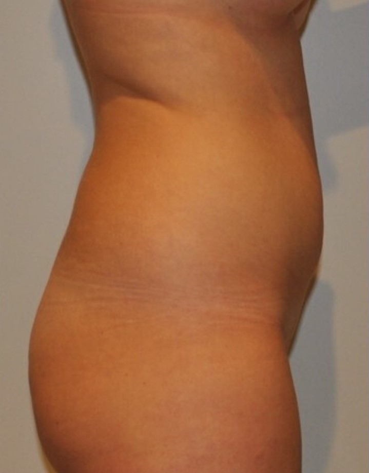 Before Image: Standard Liposuction - right-side