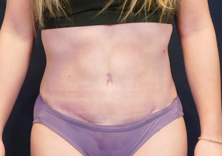 After Image: Tummy Tuck - front