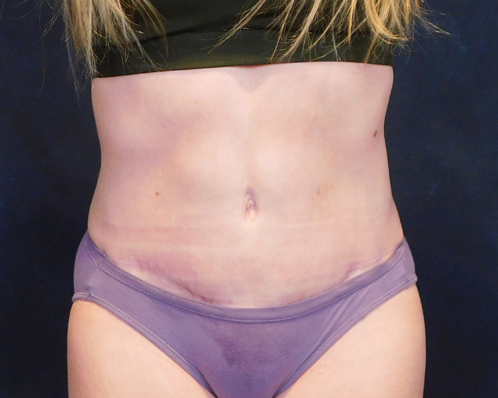 After Image: Tummy Tuck - front