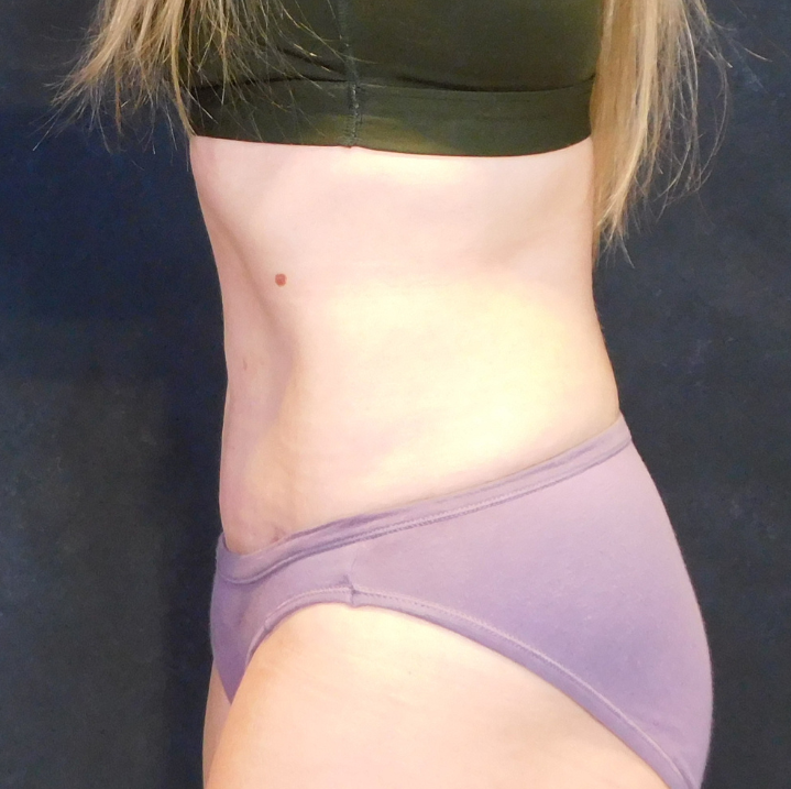 After Image: Tummy Tuck - left-side