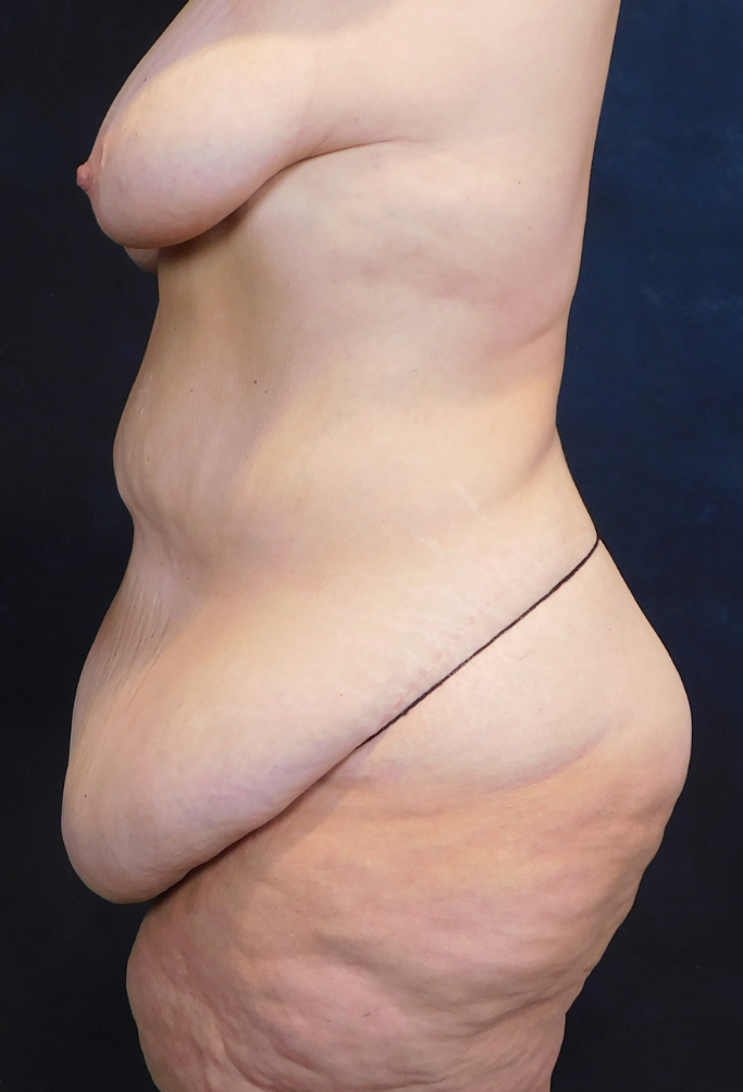 Before Image: Tummy Tuck - left-side