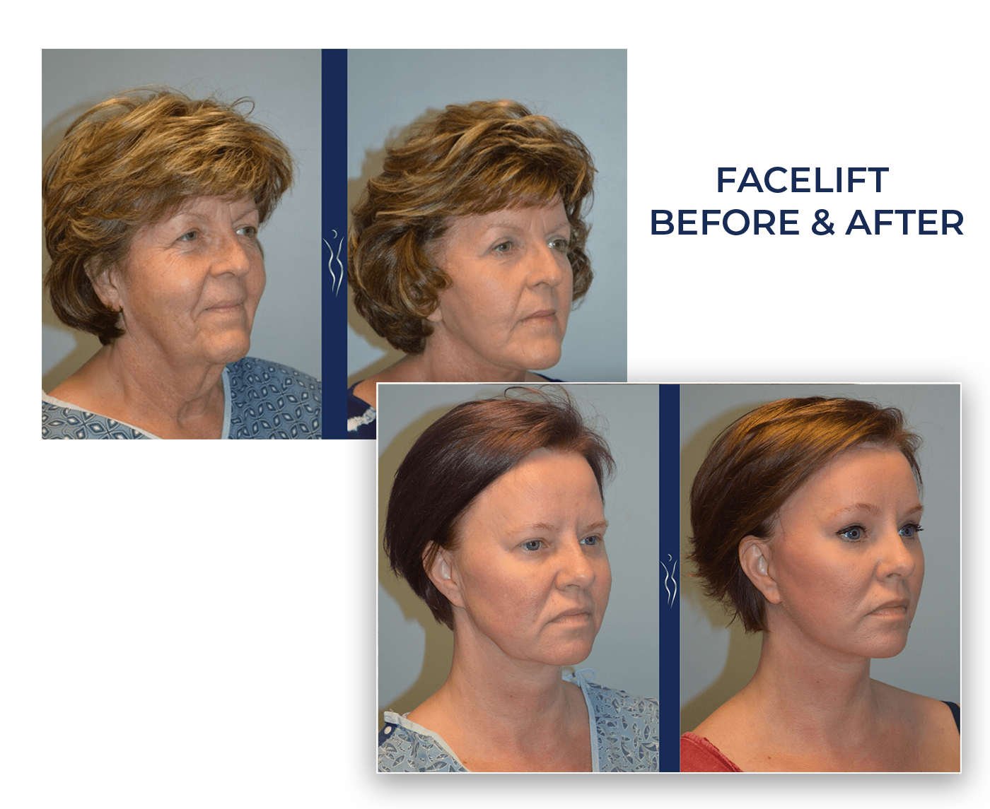 facelift b&a facelift b&a