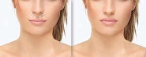 Lip Lift in Nashville, TN