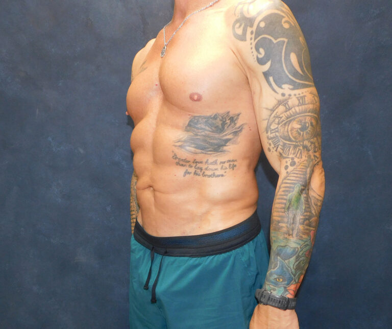 After Image: Liposuction, Renuvion - left-front-oblique