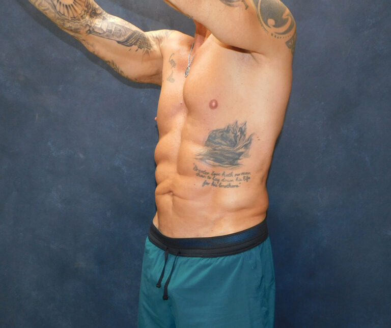 After Image: Liposuction, Renuvion - left-front-oblique