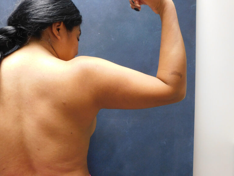 Before Image: Liposuction, Renuvion - back