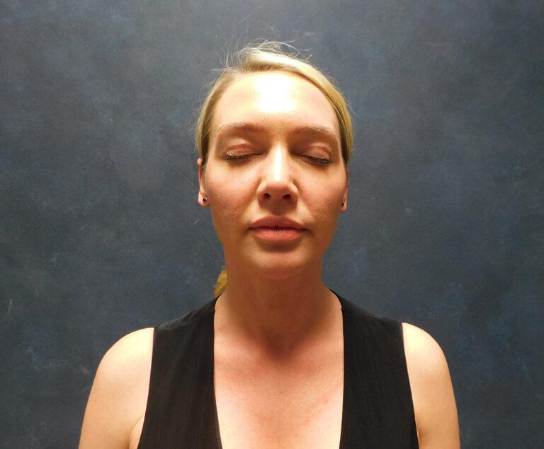 After Image: Liposuction, Renuvion - front