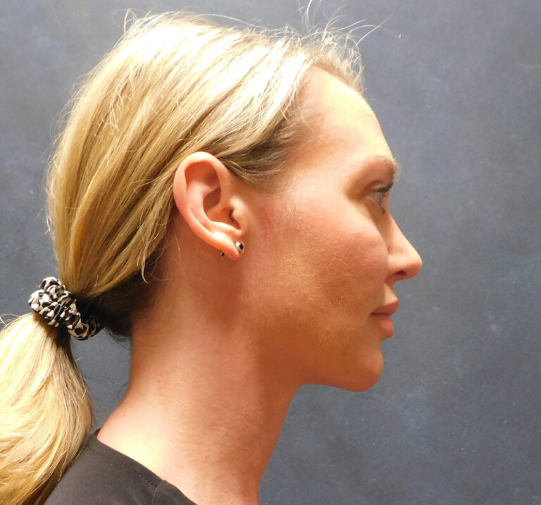 After Image: Liposuction, Renuvion - right-side