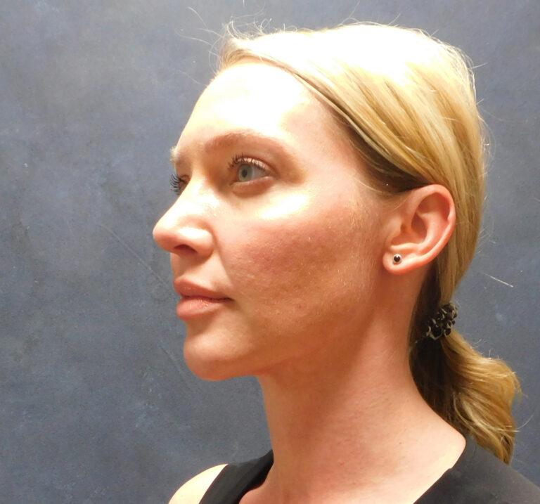 After Image: Liposuction, Renuvion - left-front-oblique