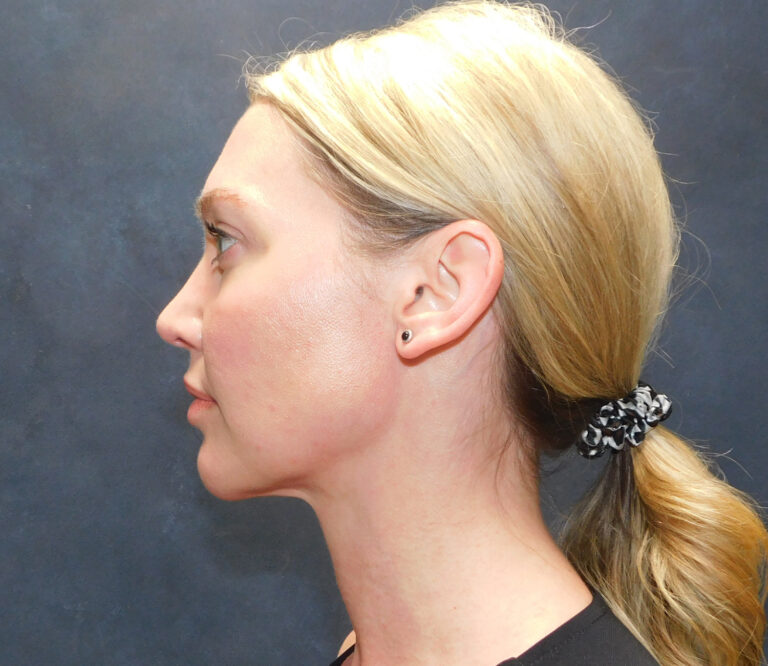 After Image: Liposuction, Renuvion - left-side