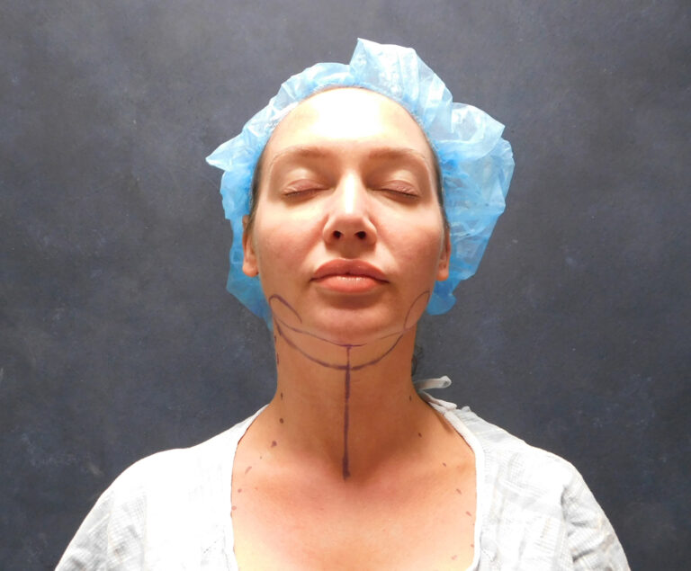 Before Image: Liposuction, Renuvion - front