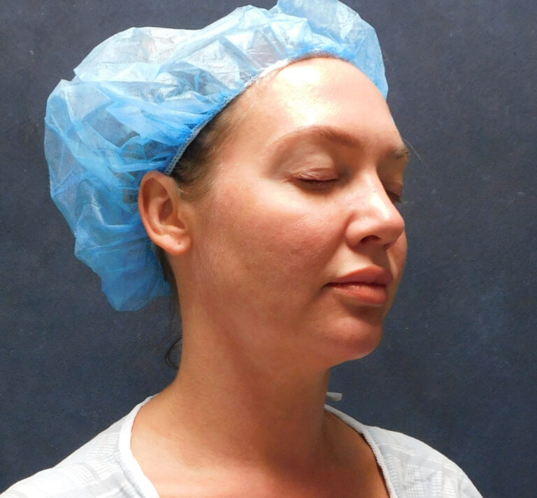 Before Image: Liposuction, Renuvion - right-front-oblique