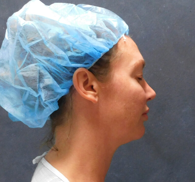 Before Image: Liposuction, Renuvion - right-side