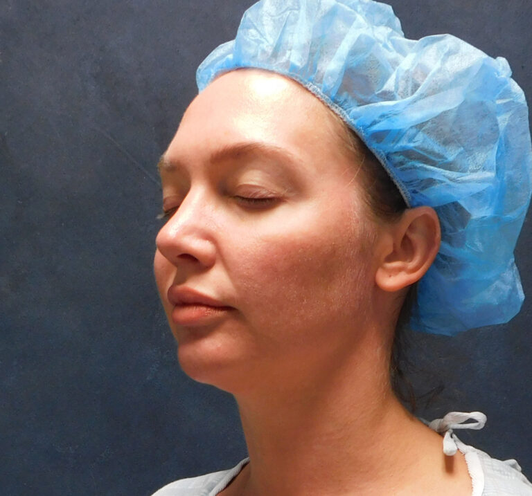 Before Image: Liposuction, Renuvion - left-front-oblique
