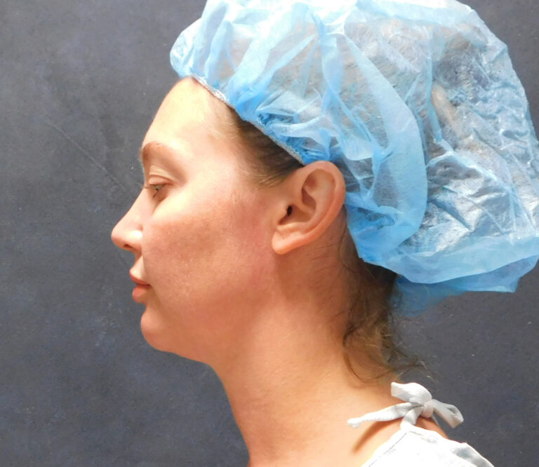 Before Image: Liposuction, Renuvion - left-side