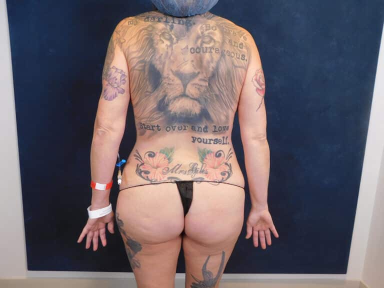 Before Image: Abdominoplasty with core liposuction, breast augmentation with mastopexy - back