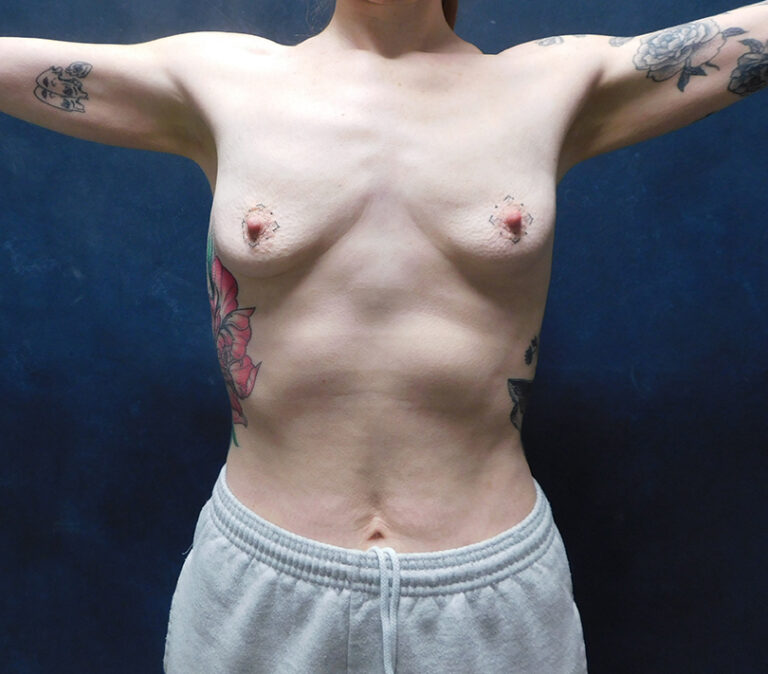 Before Image: Breast Augmentation - front