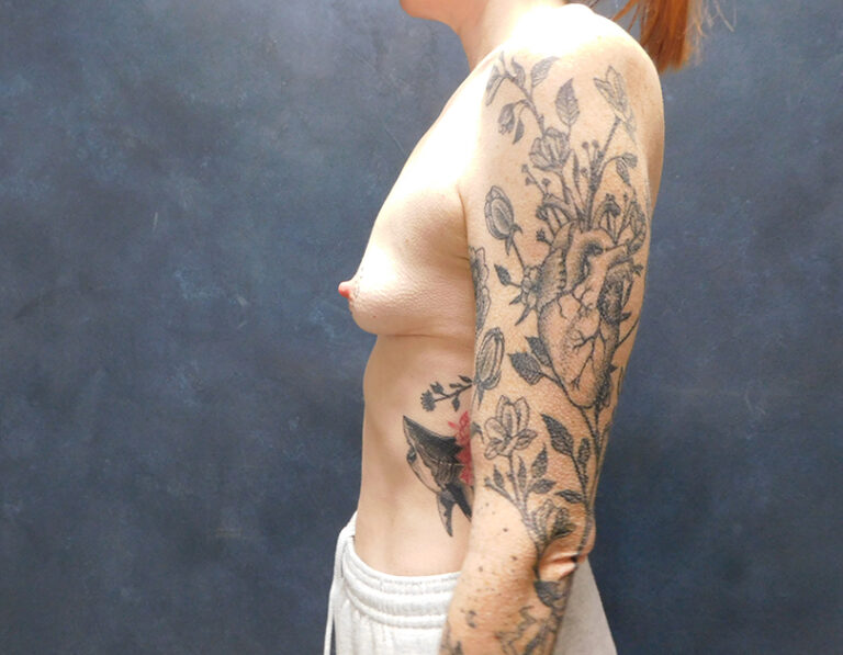 Before Image: Breast Augmentation - left-side
