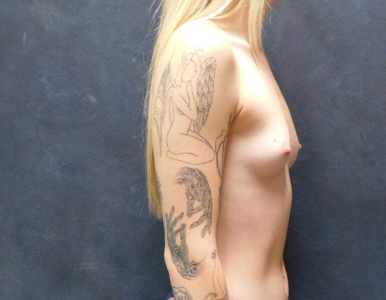 Before Image: Breast Augmentation - right-side