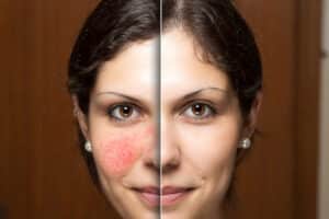Woman's side by side image, before and after rosacea treatment