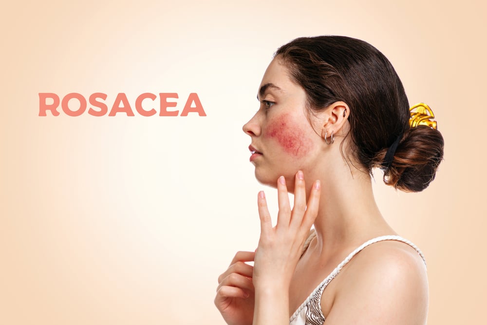 Woman with bright red cheeks in side profile, with the word "Rosacea" next to her