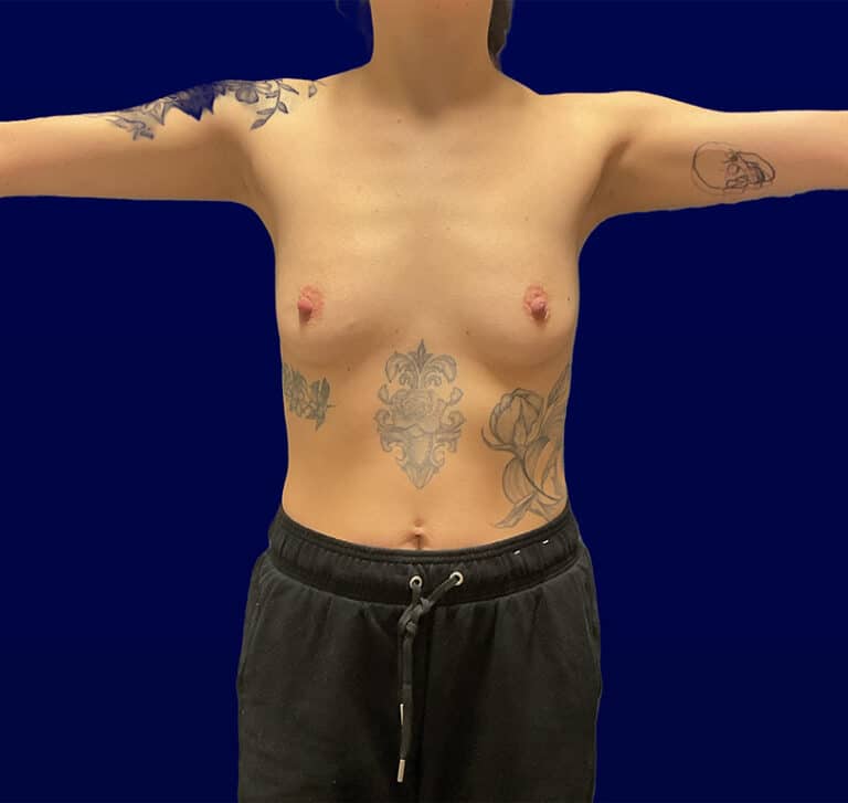 Before Image: Breast Augmentation - front