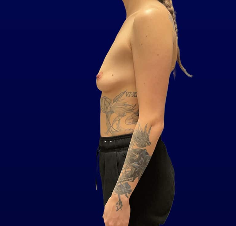 Before Image: Breast Augmentation - left-side