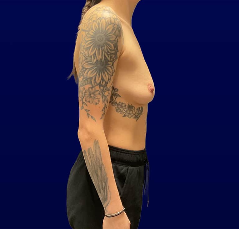 Before Image: Breast Augmentation - right-side