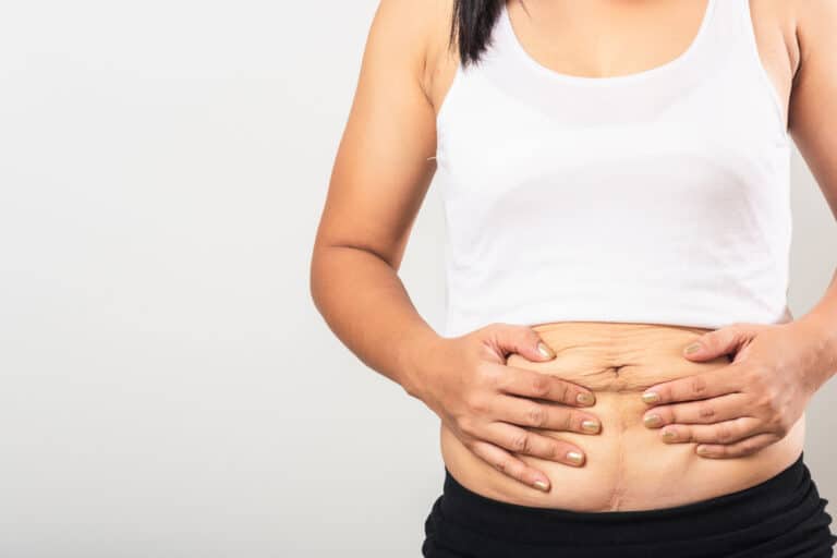 After Ozempic weight loss, young woman holds her belly skin and considers body contouring