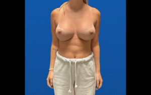 After Image: Breast Augmentation