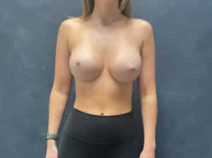 After Image: Breast Augmentation