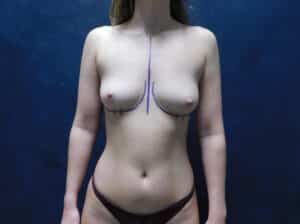 Before Image: Breast Augmentation