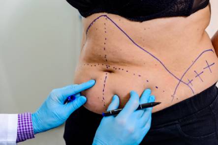 Doctor marks a patient's stomach to plan a tummy tuck